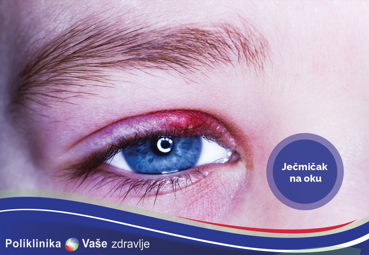 Ječmičak na oku
